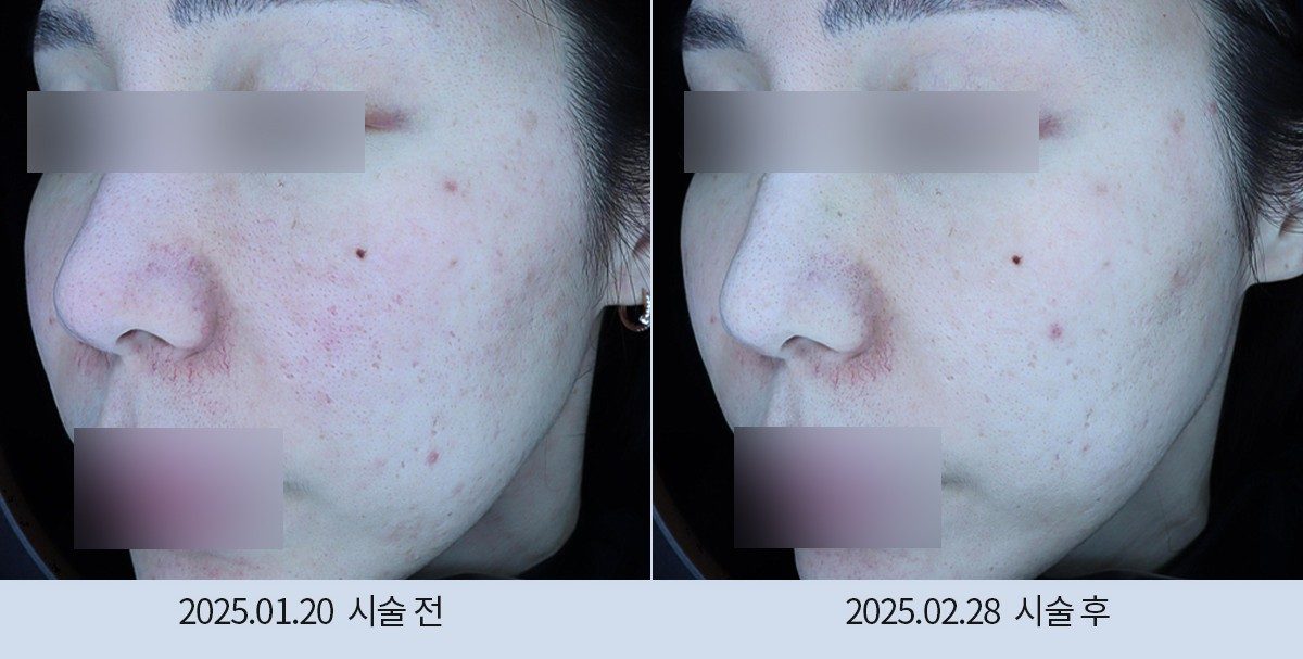스노우의원 다산점 여드름·붉은기 시술 전후