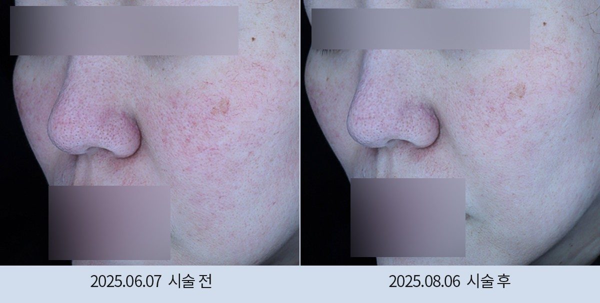 스노우의원 다산점 여드름·붉은기 시술 전후