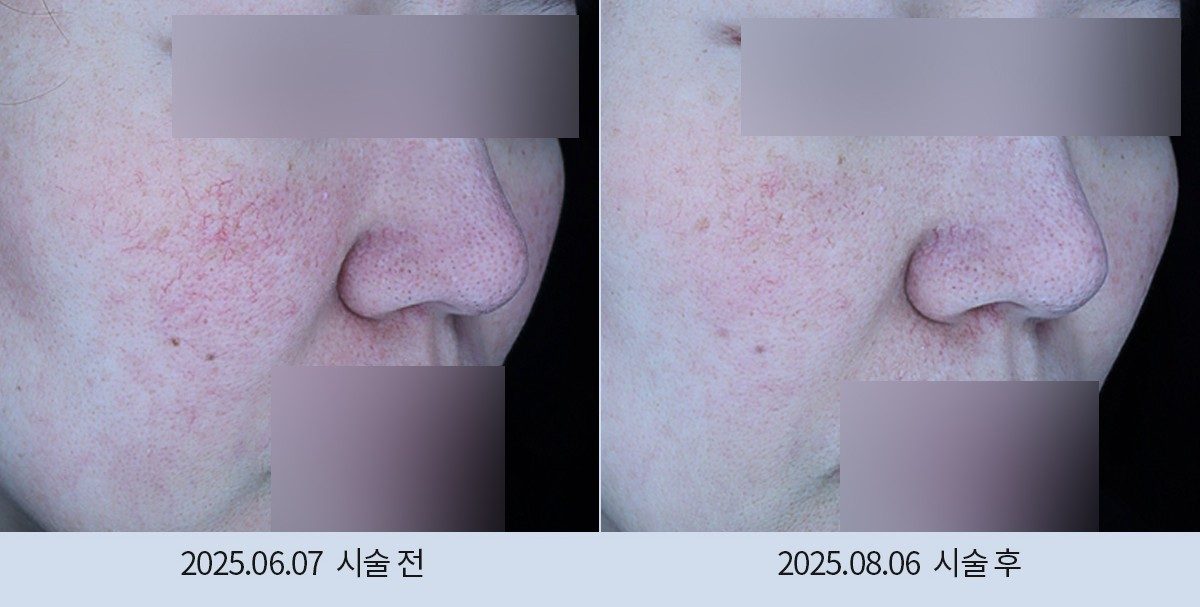 스노우의원 다산점 여드름·붉은기 시술 전후