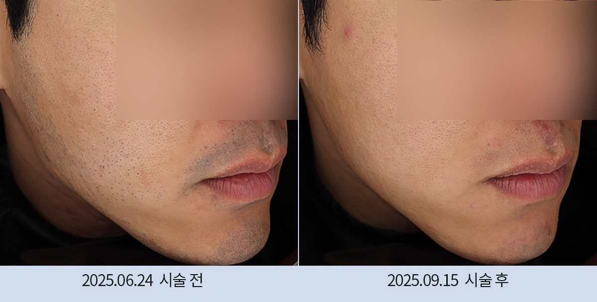스노우의원 다산점 레이저 제모 전후