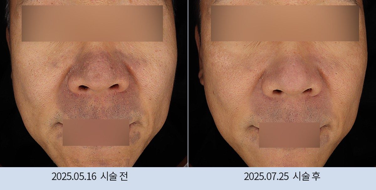 스노우의원 다산점 색소 시술 전후