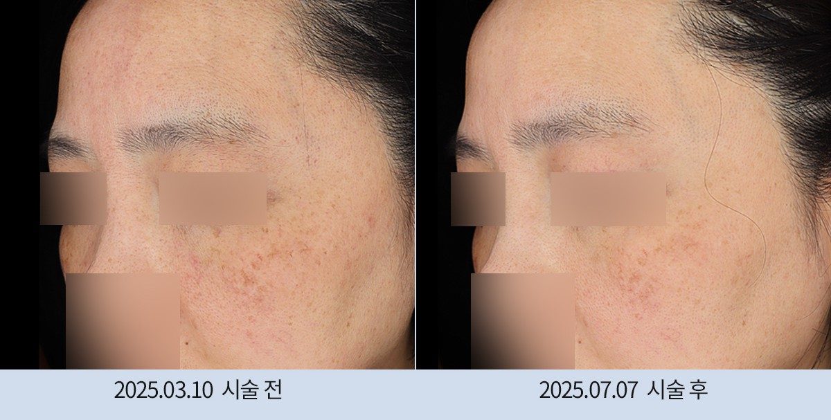 스노우의원 다산점 색소 시술 전후