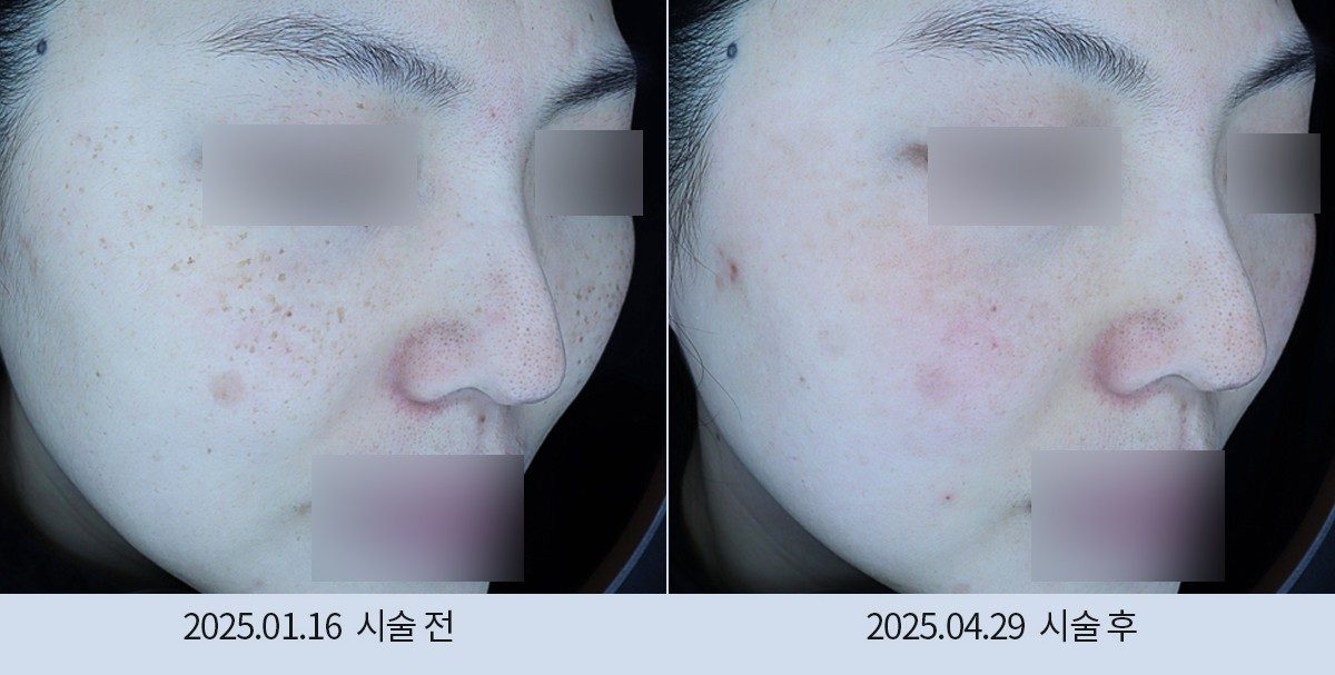 스노우의원 다산점 색소 시술 전후