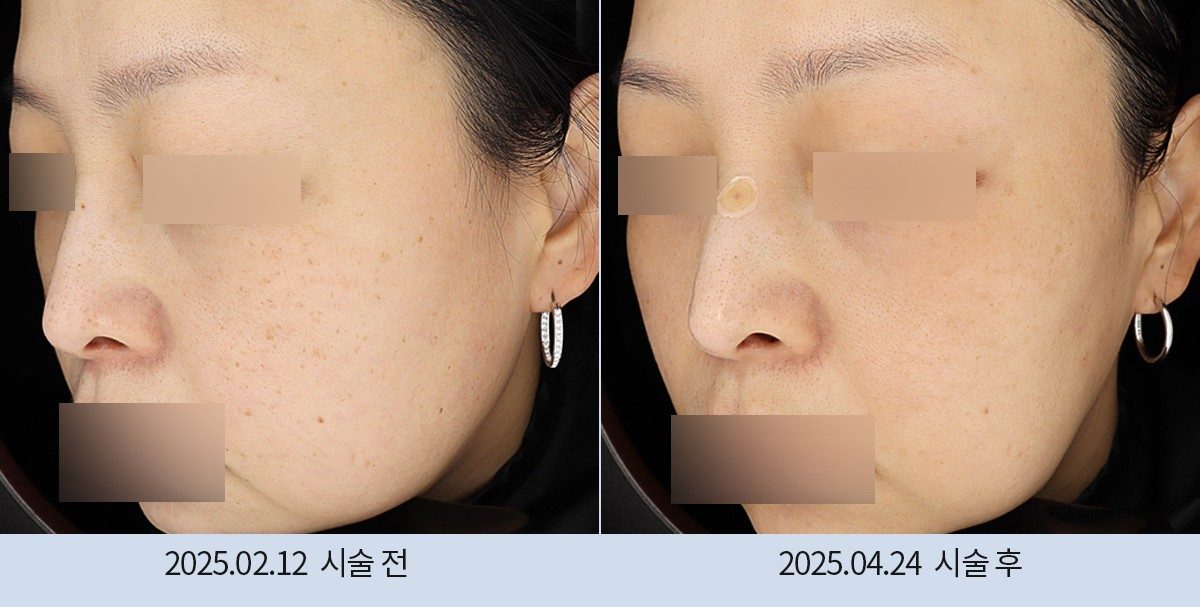 스노우의원 다산점 색소 시술 전후